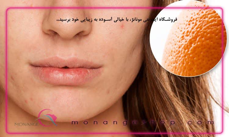 روش جلوگیری از ایجاد پوست پرتقالی