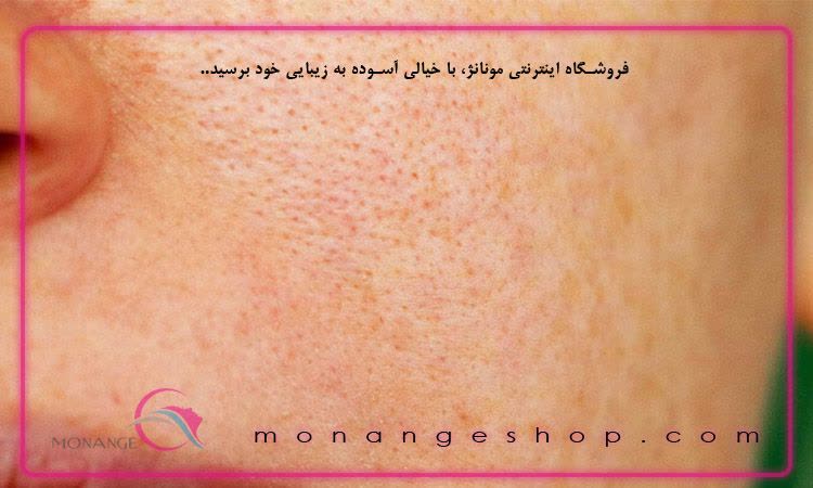 آیا پوست پرتقالی قابل اصلاح است