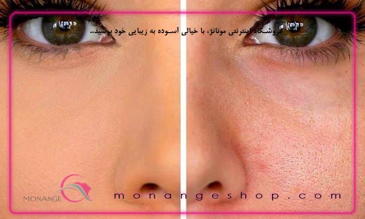 روش درمان گیاهی پوست پرتقالی