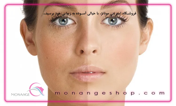 چرا پوستم تیره شده و نحوه درمان