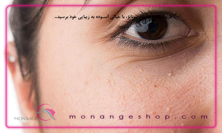 راه های درمان میلیا