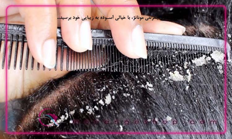 نشانه شوره سر