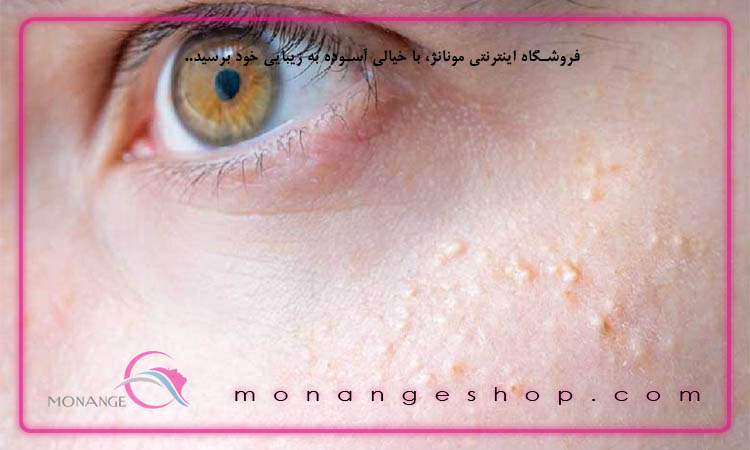 چگونه با میلیا برخورد کنیم
