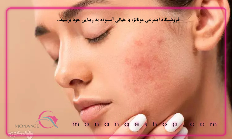 چگونه ویتامین c به درمان جای جوش کمک می کند