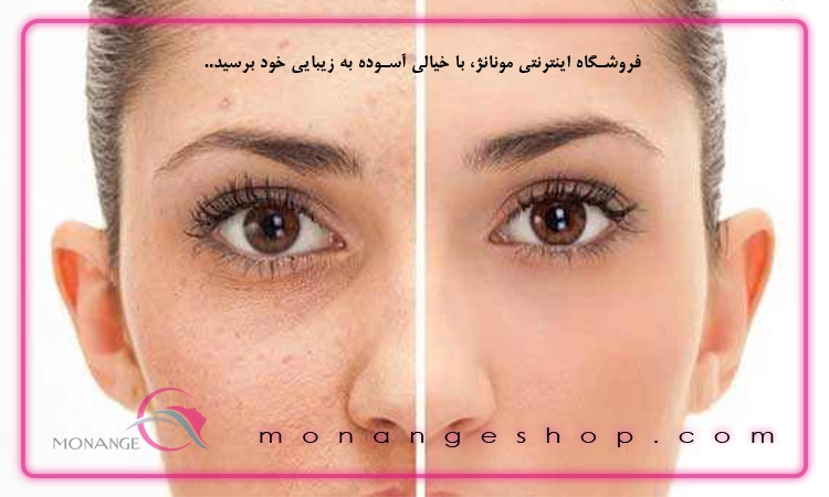 دلایل ظاهر شدن آکنه