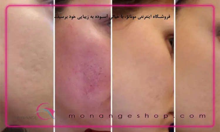 درمارولینگ خانگی میکرونیدلینگ