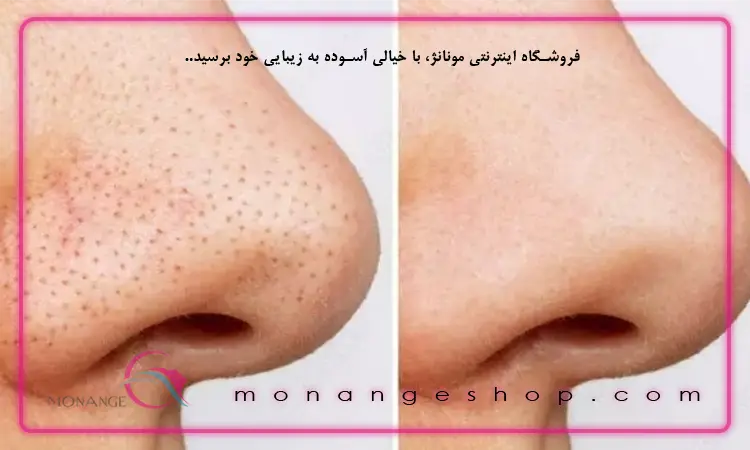 راه های از بین بردن جوش سر سیاه بینی