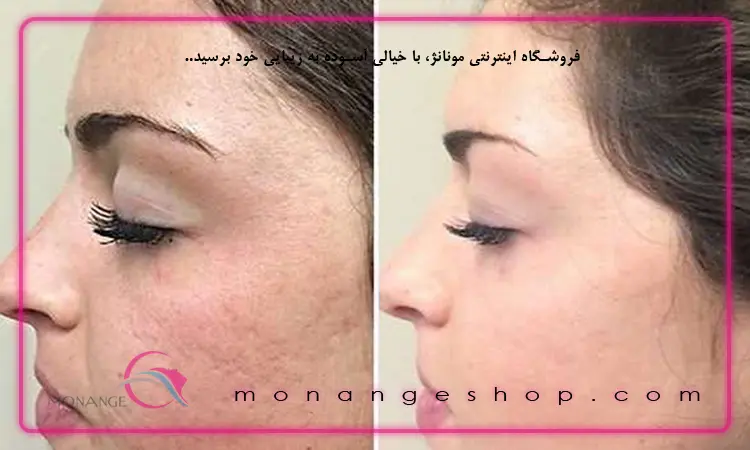 انجام میکرونیدلینگ