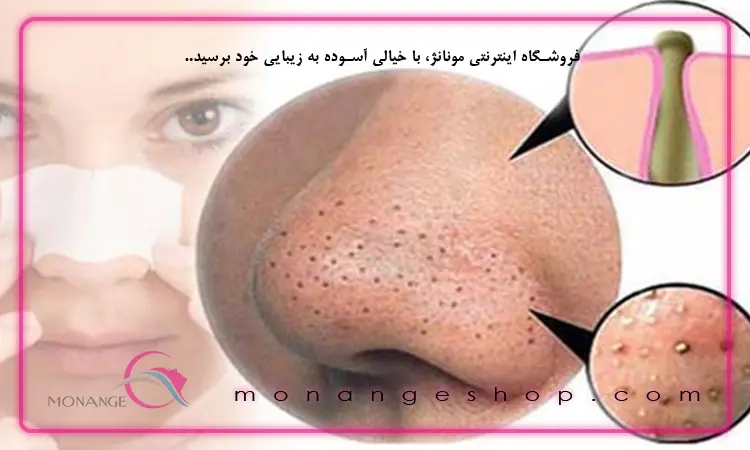 علت بوجود آمدن جوش سر سیاه بینی چیست؟