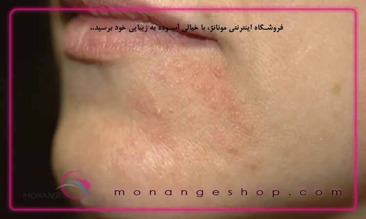 خشکی پوست