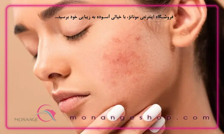 ایجاد کننده لک پوستی