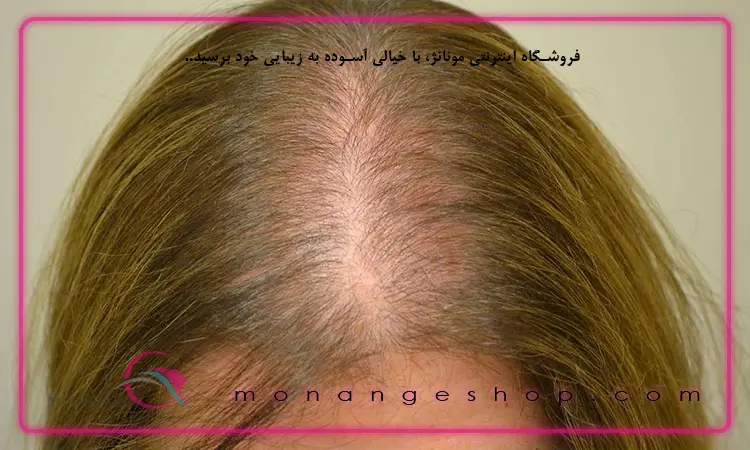 ریزش موی عصبی
