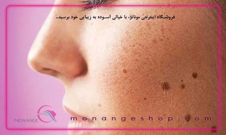 لک های پوست