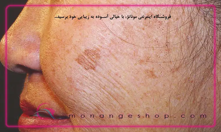 رنگ لکه‌ های پوستی