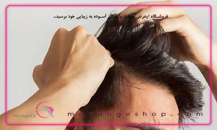 ریزش موی عصبی