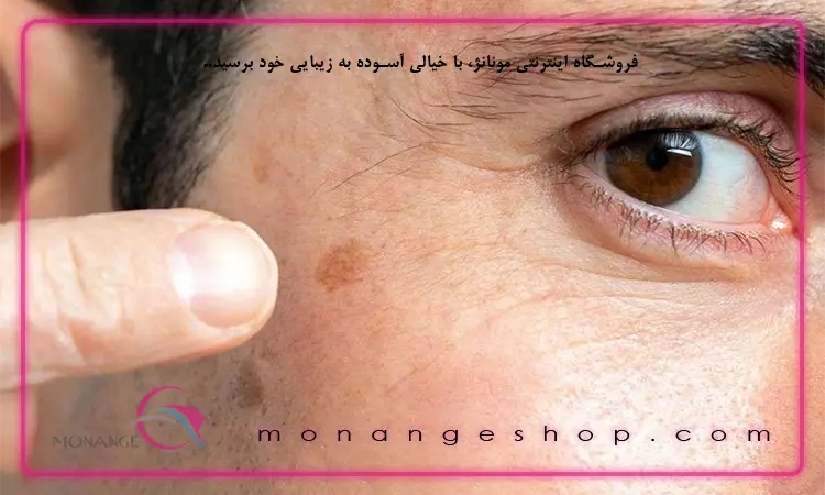 دلایل بروز لکه‌ های ناگهانی روی پوست