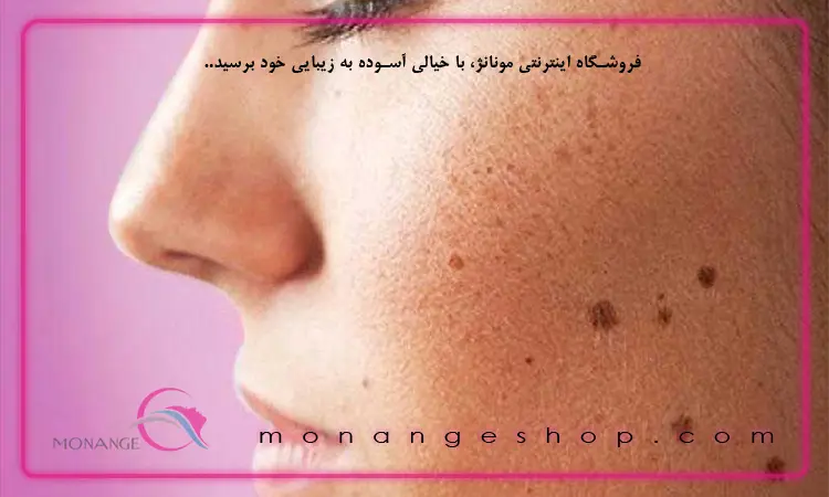 لکه‌ قهوه ای