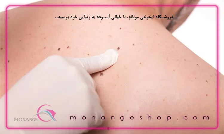 لکه‌ پوستی