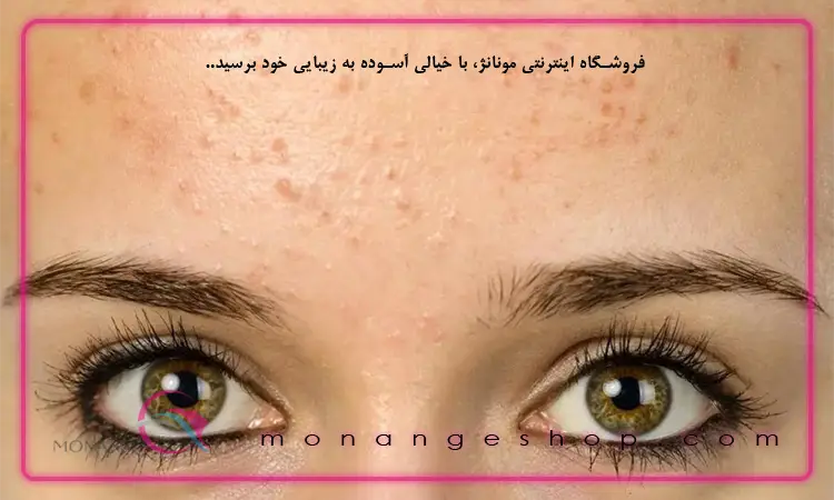 جوش زدن پوست صورت