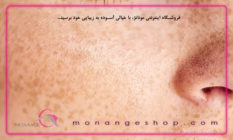 انواع لک‌ های پوستی کدامند