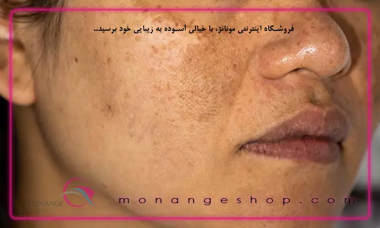 درمانی لک های پوستی