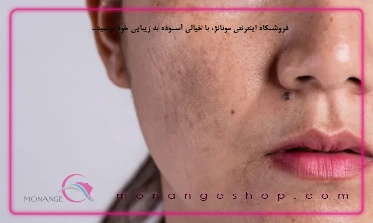 روش درمان لک پوستی