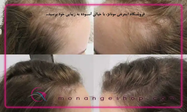 ریزش مو مردانه
