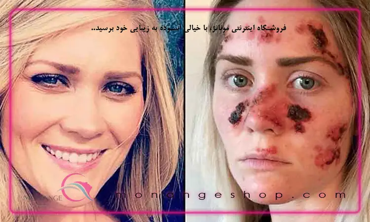 عوارض برنزه شدن پوست