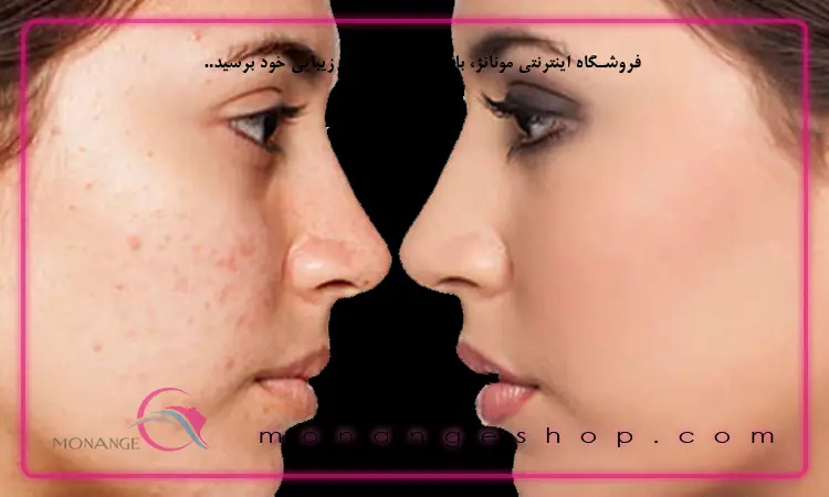 راه‌ های درمان جوش‌ های زیر پوستی
