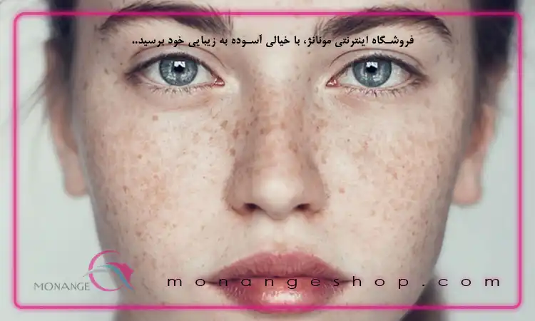 دلایل ایجاد شدن کک و مک روی پوست