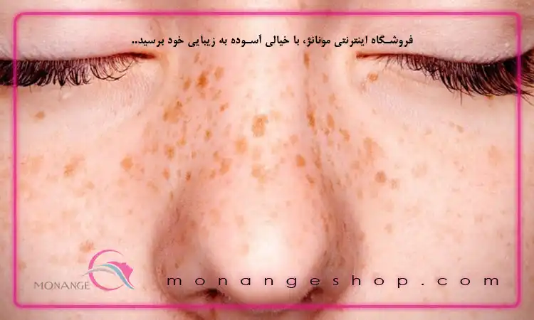 راه‌ های پیشگیری کک و مک