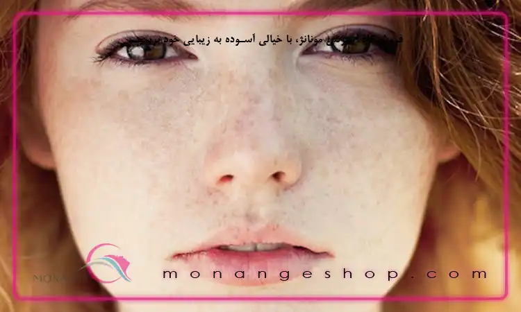 نور خورشید؛ عامل محرک برای ظهور کک و مک
