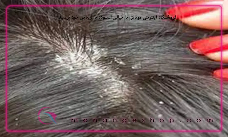 روش درمان شپش سر