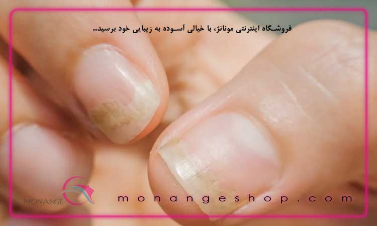 نحوه درمان قارچ ناخن