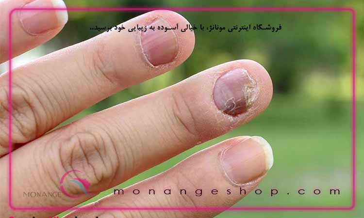 نشانه اولیه قارچ ناخن