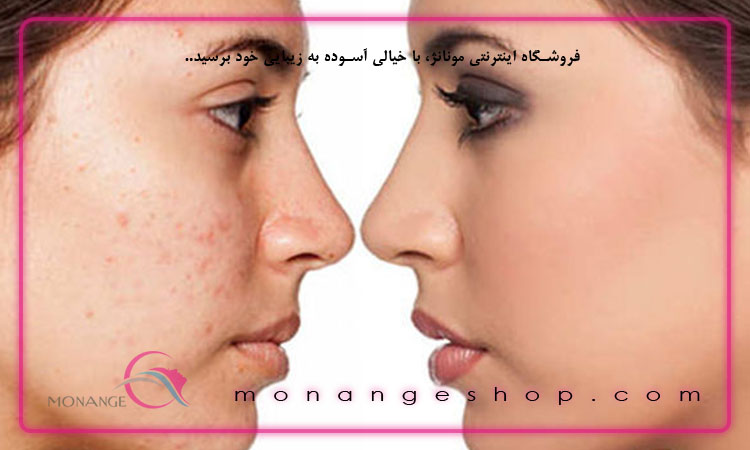 برای جلوگیری از جوش صورت چه کنیم