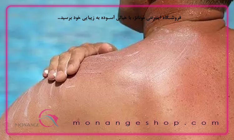 پیشگیری از آفتاب سوختگی
