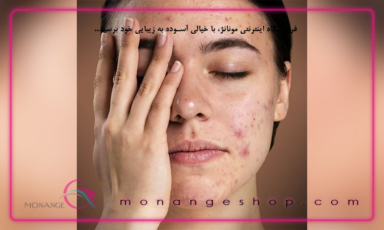 روش کاهش جوش‌ های صورت